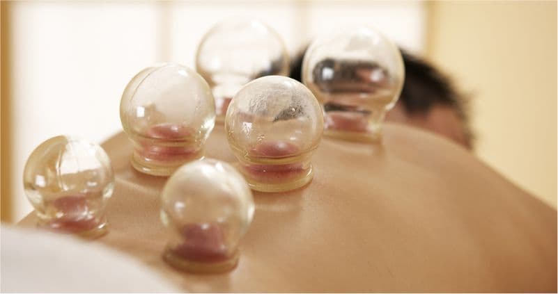 Cupping at Amazing Physiotherapy